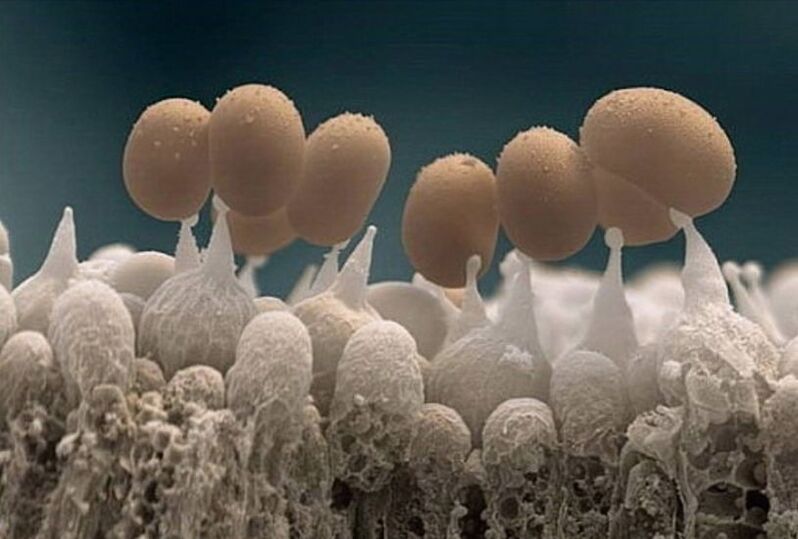 μύκητας των νυχιών κάτω από μικροσκόπιο