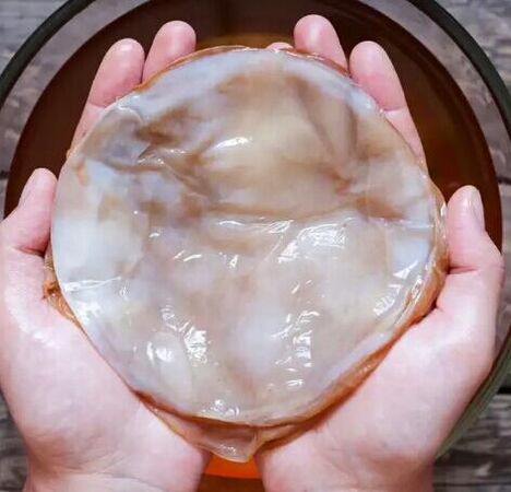 μύκητας νυχιών kombucha